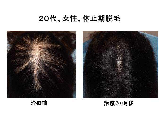 円形脱毛症　名医""